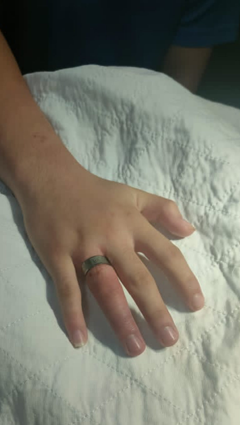 Bomba Sandakan Potong Cincin Tersekat Di jari Remaja Lelaki