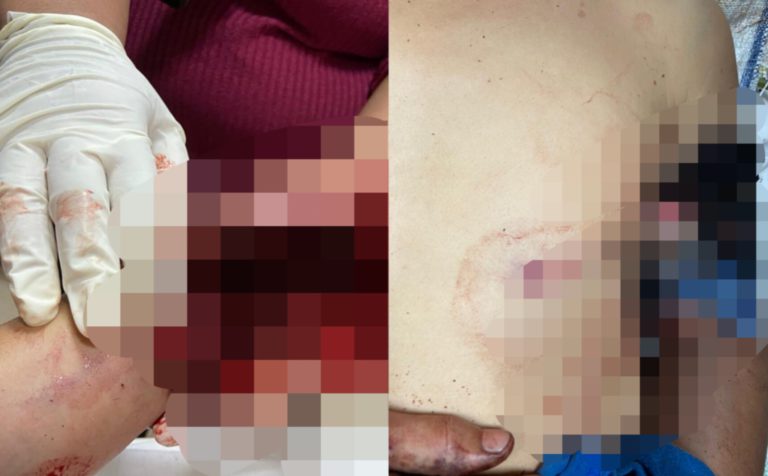 Petani cedera parah tertembak diri sendiri dengan senapang ‘bakakuk’